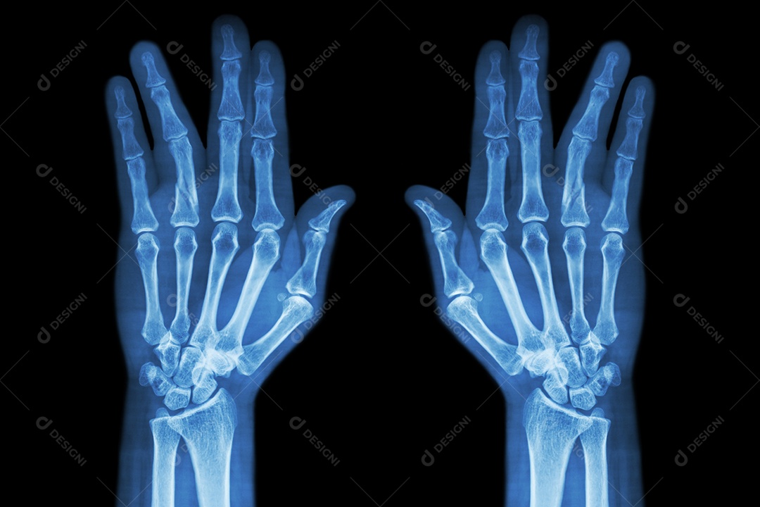 Fratura da diáfise da falange proximal do dedo anular