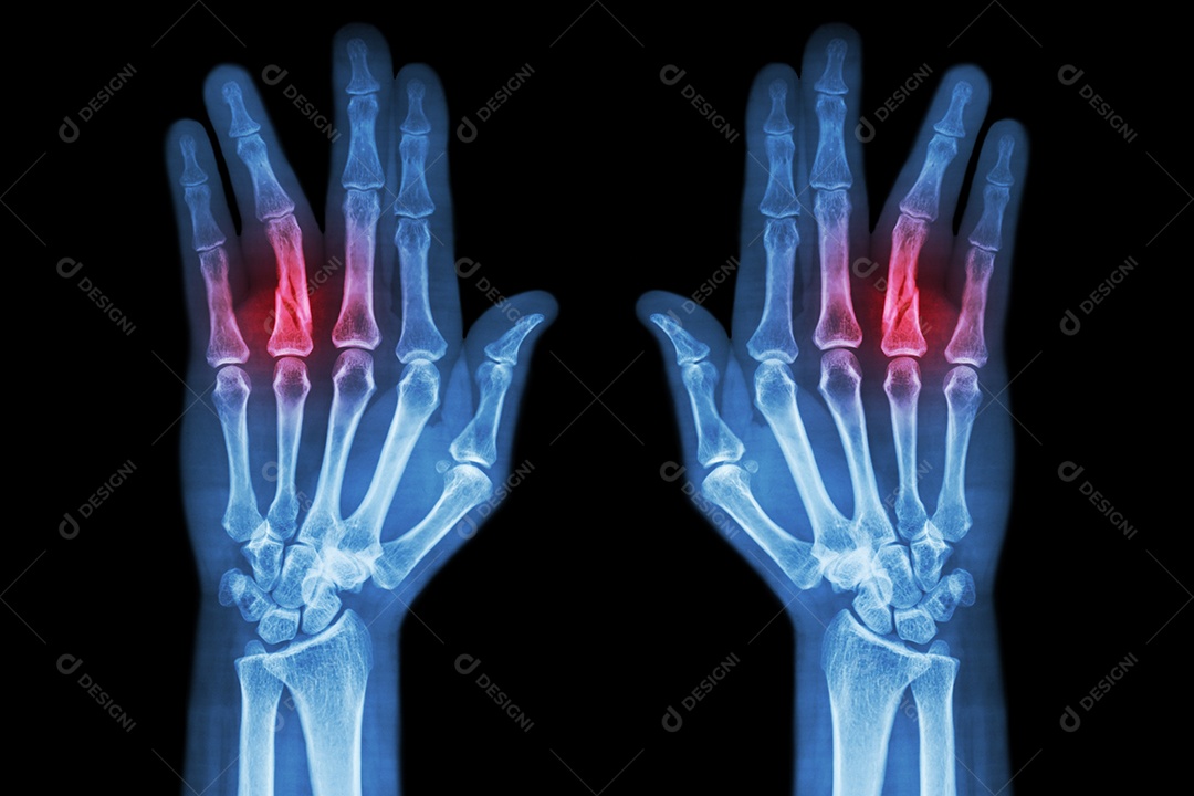 Fratura da diáfise da falange proximal do dedo anular raio x de ambas as mãos AP