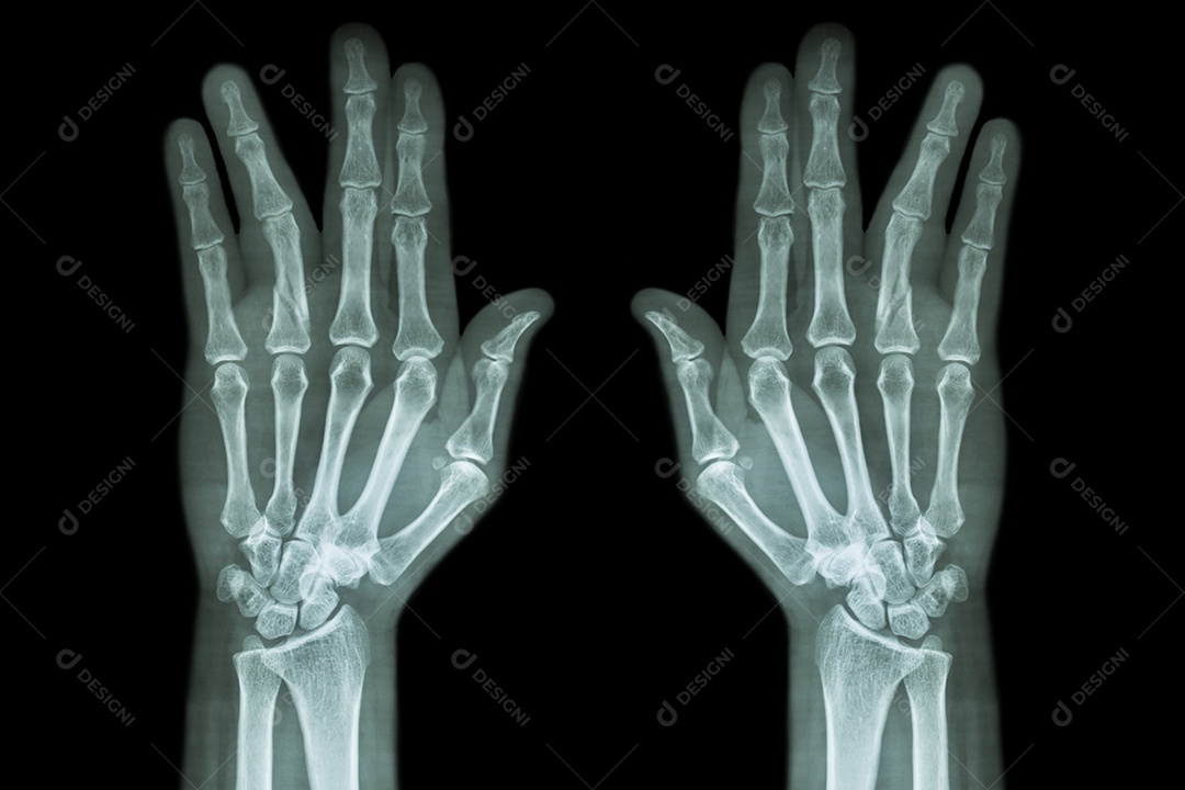 Fratura da diáfise da falange proximal do dedo anular raio x de ambas as mãos AP