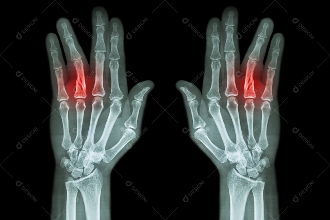 Fratura da diáfise da falange proximal do dedo anular raio x de ambas as mãos AP