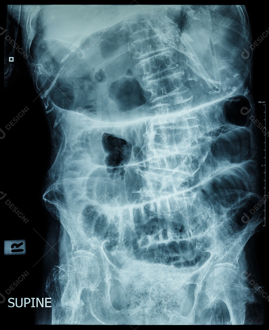 Um raio x do abdômen em posição supina