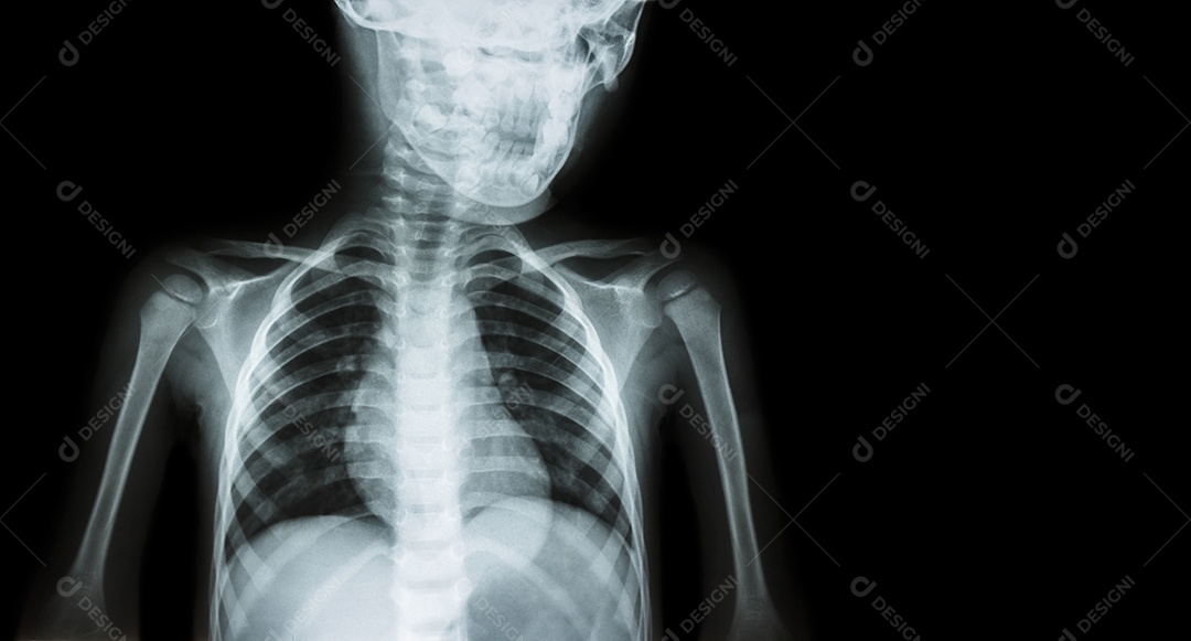 Raio x do corpo da criança e área em branco no lado direito