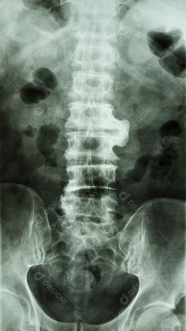 Espondilose e escoliose raio x da coluna lombar e sacro mostra coluna torta