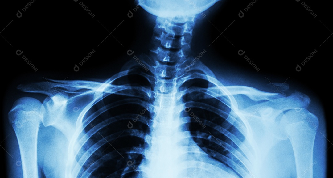 Radiografia de filme AP de ambas as clavículas vista frontal