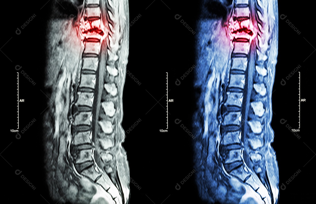 Metástase na coluna disseminação do câncer para a coluna torácica