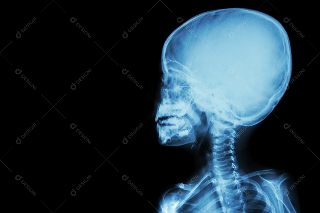 Filme raio x do corpo da criança e dor de cabeça