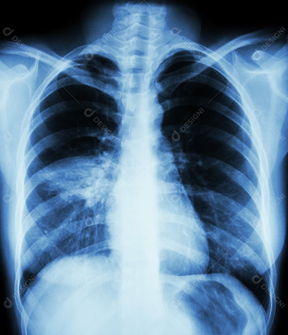 Pneumonia com insuficiência respiratória