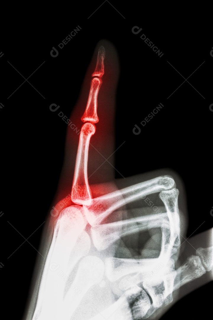 Filme raio x dedo indicador e mão apontar um dedo