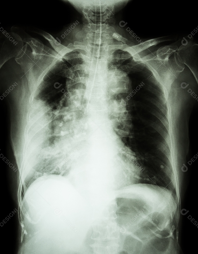 Radiografia de tórax pneumonia e derrame pleural direito.