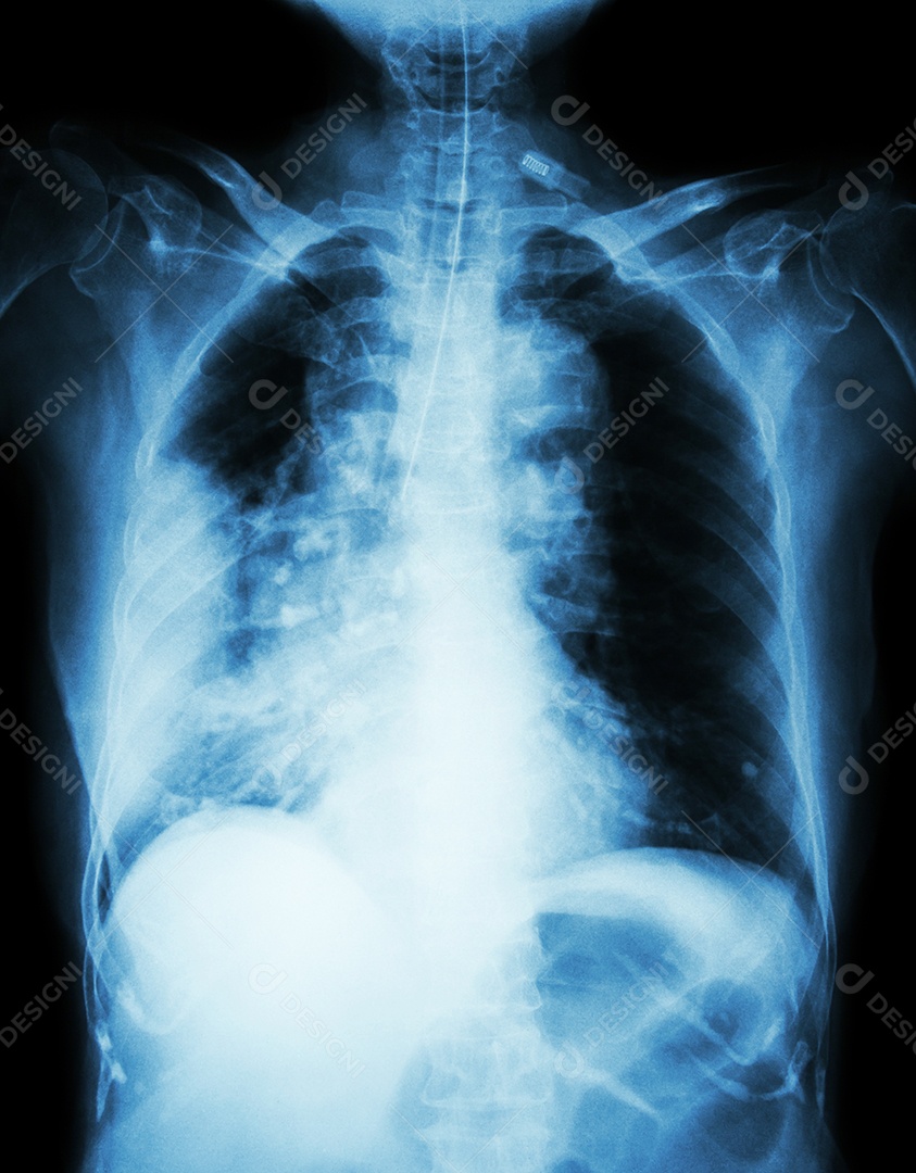 Radiografia de tórax pneumonia e derrame pleural direito.