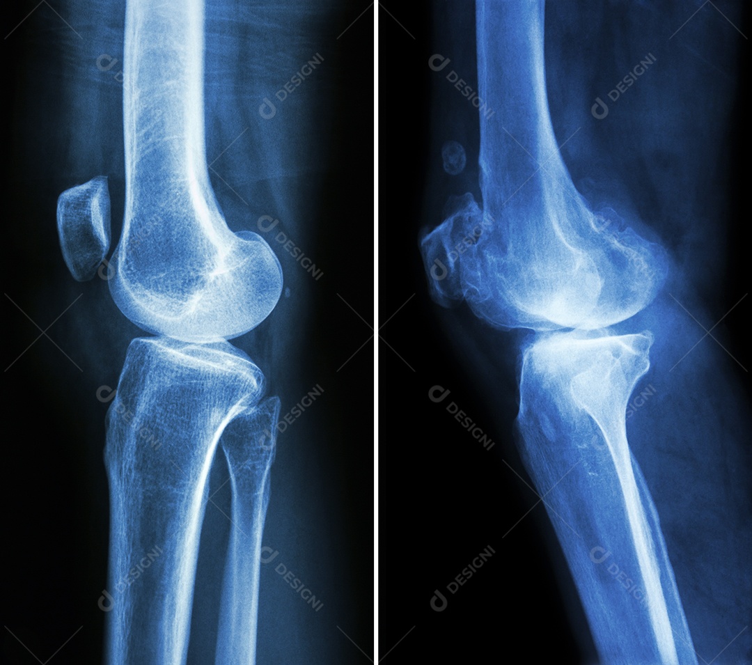 Joelho normal imagem à esquerda e joelho com osteoartrite