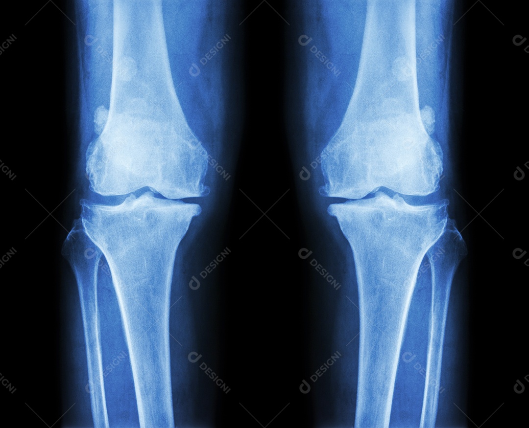 Joelho normal imagem à esquerda e joelho com osteoartrite