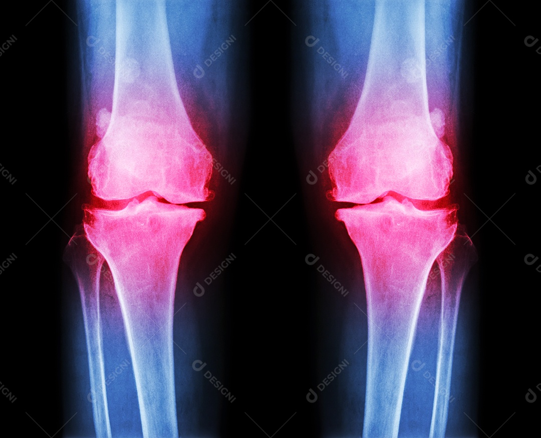Joelho normal imagem à esquerda e joelho com osteoartrite