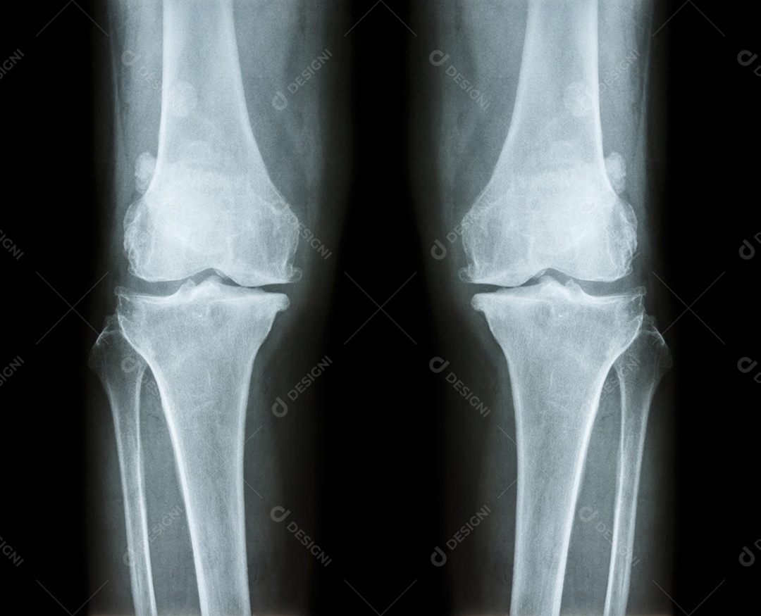Joelho normal imagem à esquerda e joelho com osteoartrite