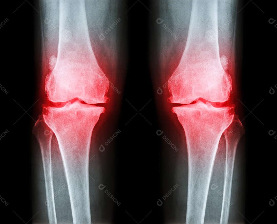 Joelho normal imagem à esquerda e joelho com osteoartrite