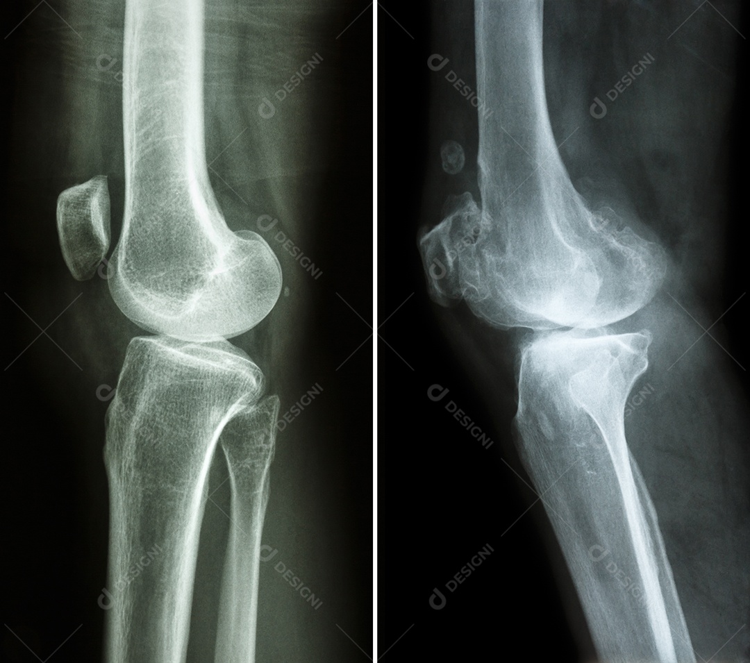 Joelho normal imagem à esquerda e joelho com osteoartrite