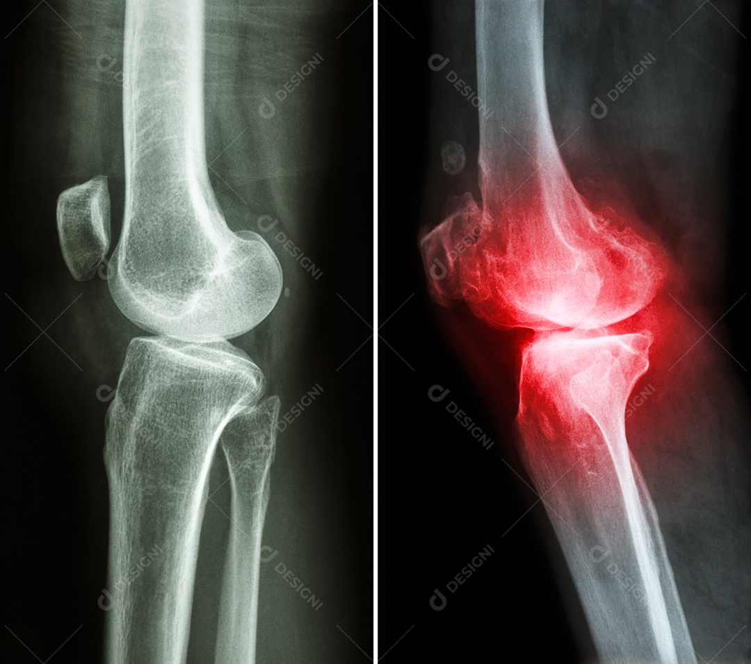 Joelho normal imagem à esquerda e joelho com osteoartrite