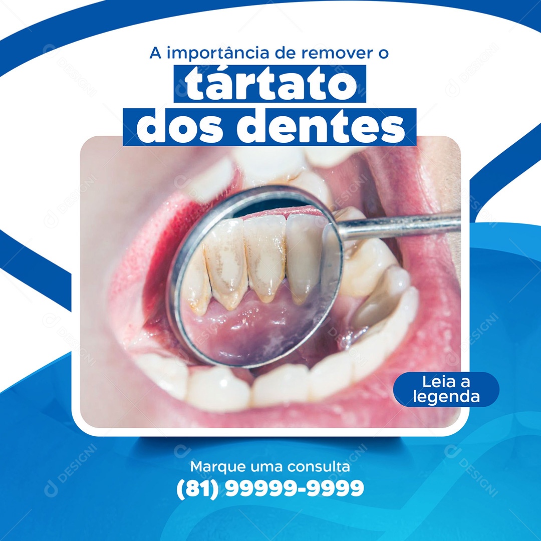 Post Odontologia Tártaro Nos Dentes Social Media PSD Editável