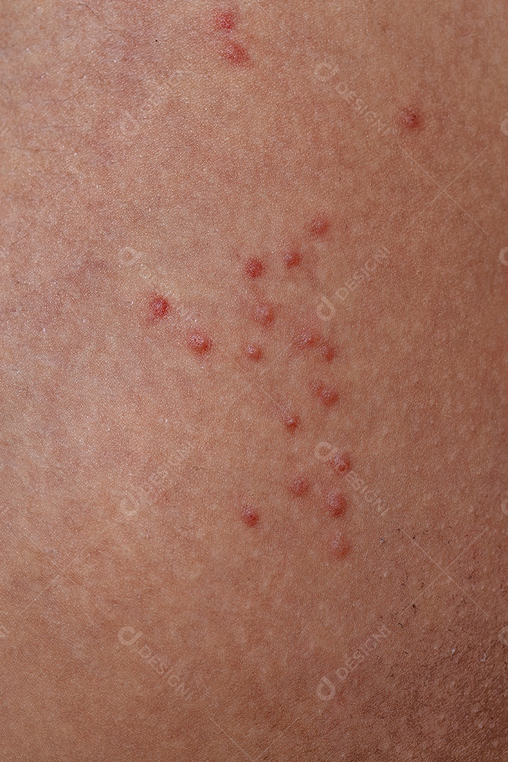 Pele humana com várias reações alérgicas a picadas de carrapatos
