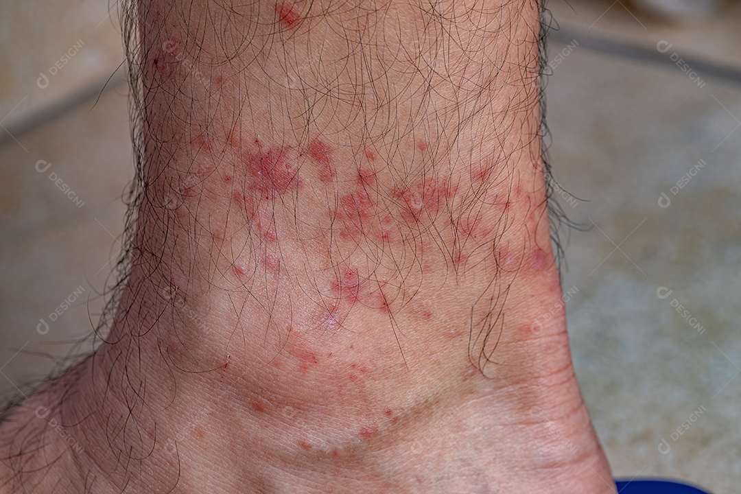 Pele humana com várias reações alérgicas a picadas de carrapatos