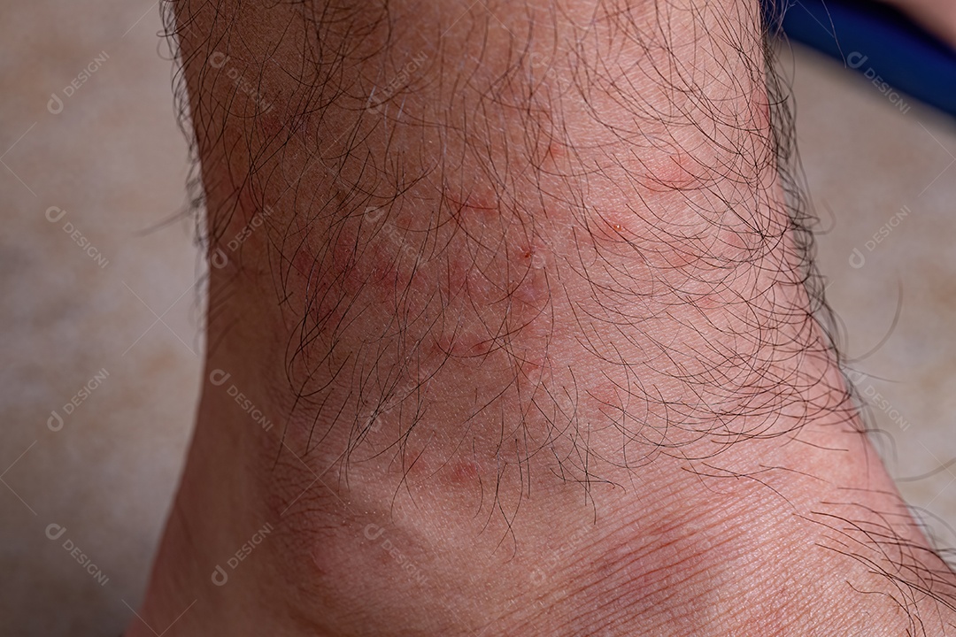 Pele humana com várias reações alérgicas a picadas de carrapatos