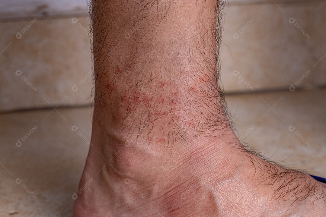 Pele humana com várias reações alérgicas a picadas de carrapatos