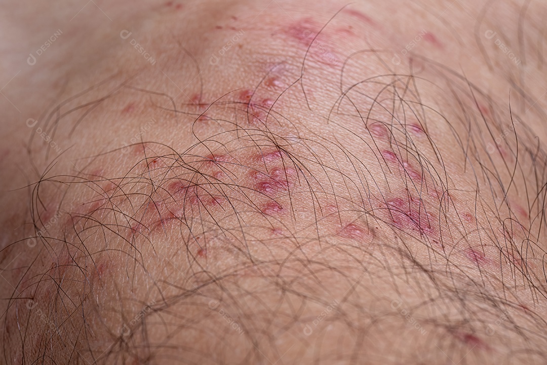 Pele humana com várias reações alérgicas a picadas de carrapatos