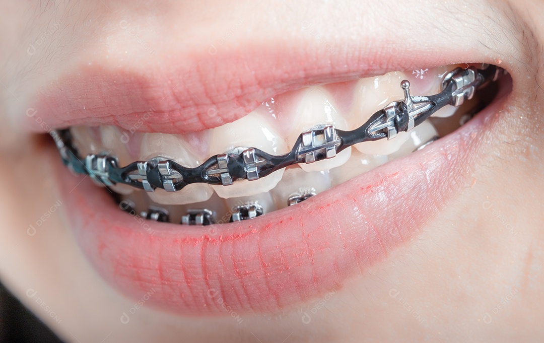 O aparelho dentário da jovem mulher asiática usando aparelho