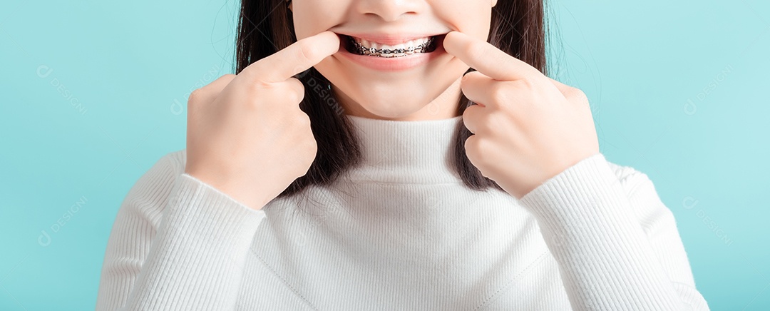 O aparelho dentário da jovem mulher asiática usando aparelho