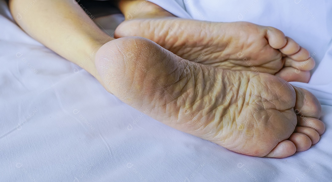 Close de calcanhar rachado