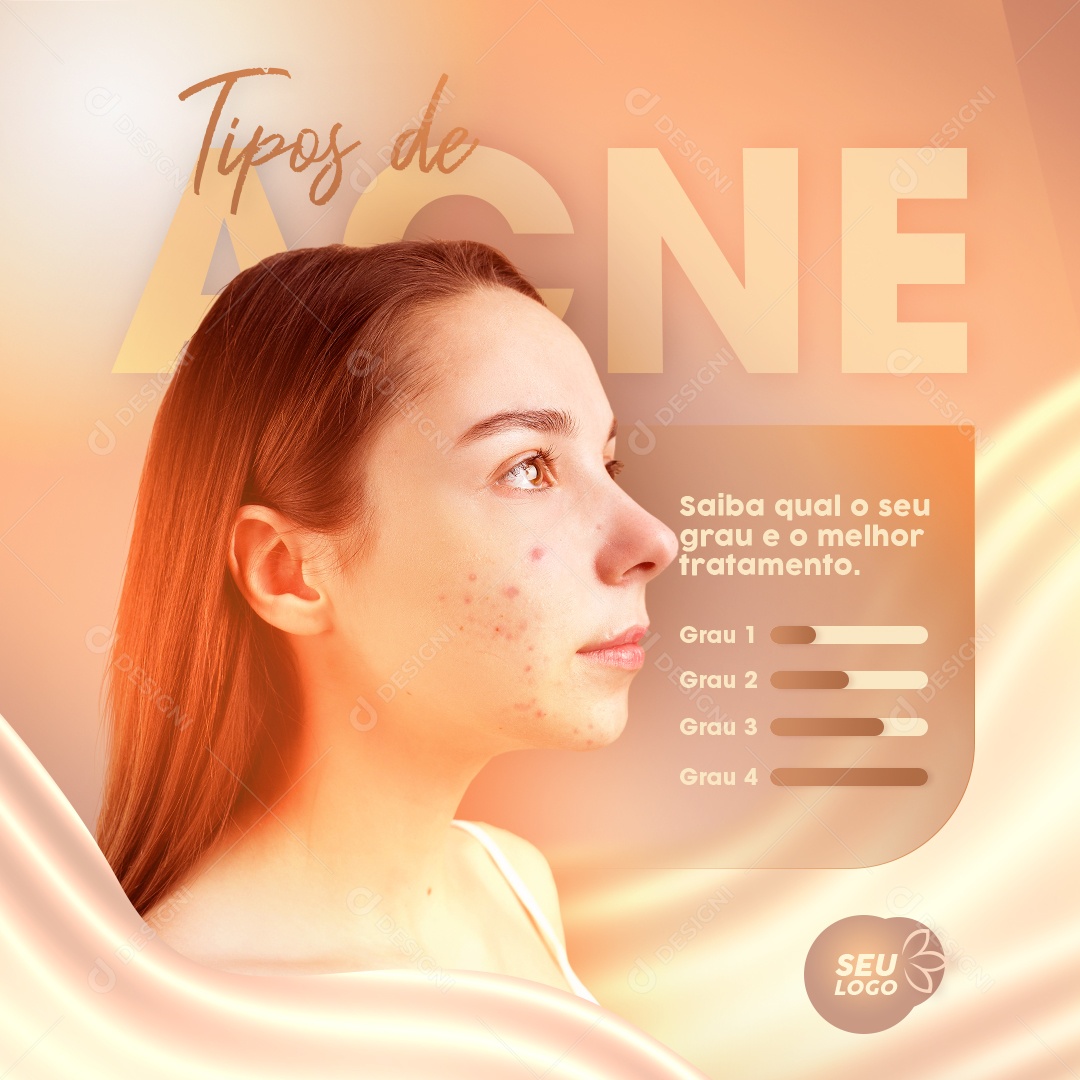 Social Media Tipos De Acne O Melhor Tratamento PSD Editavel
