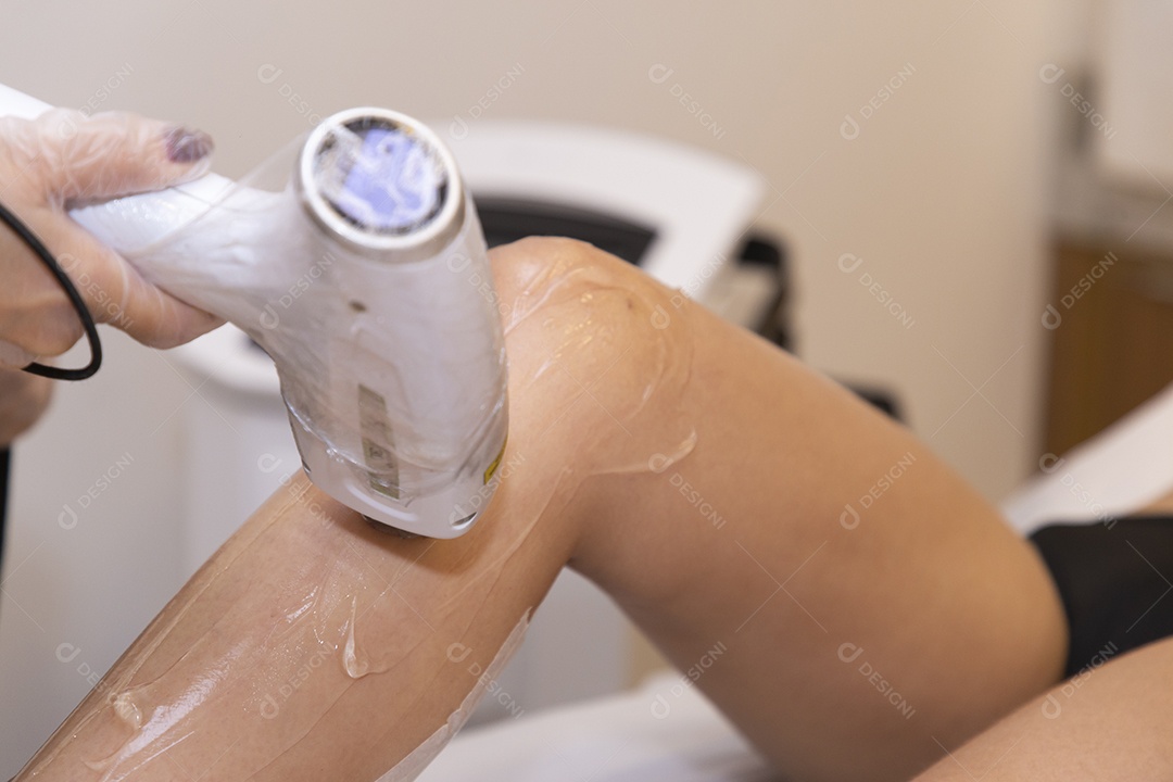 Mulher realizando procedimentos de depilação a laser