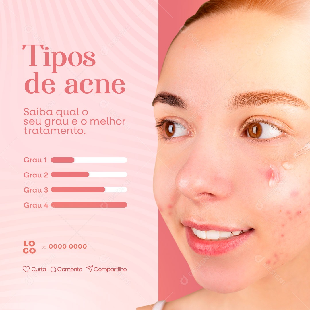 Tipos De Acne Clínica de Estética Social Media PSD Editável