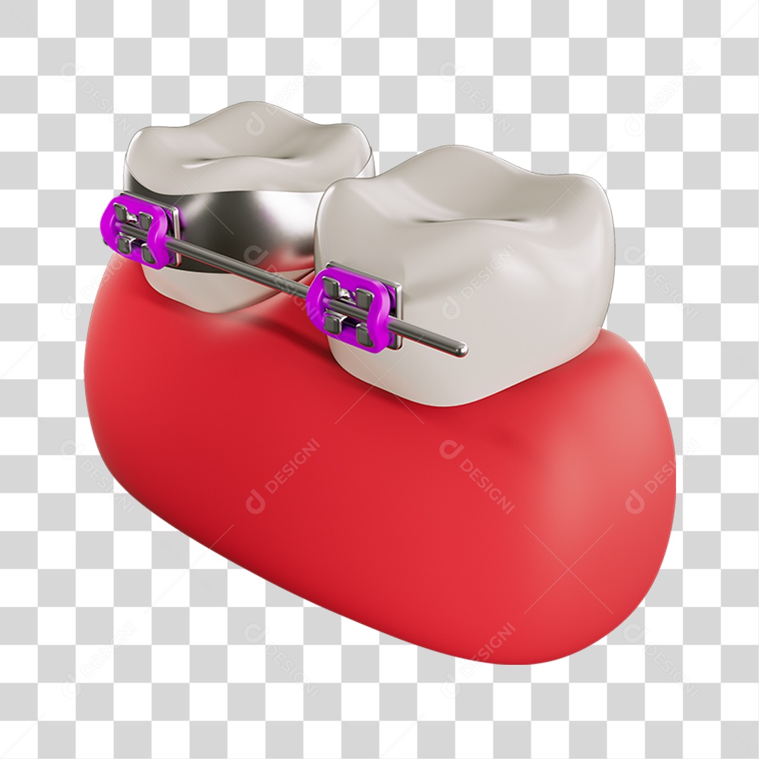 Elemento 3D Dente com Aparelhos Para Composição PNG Transparente
