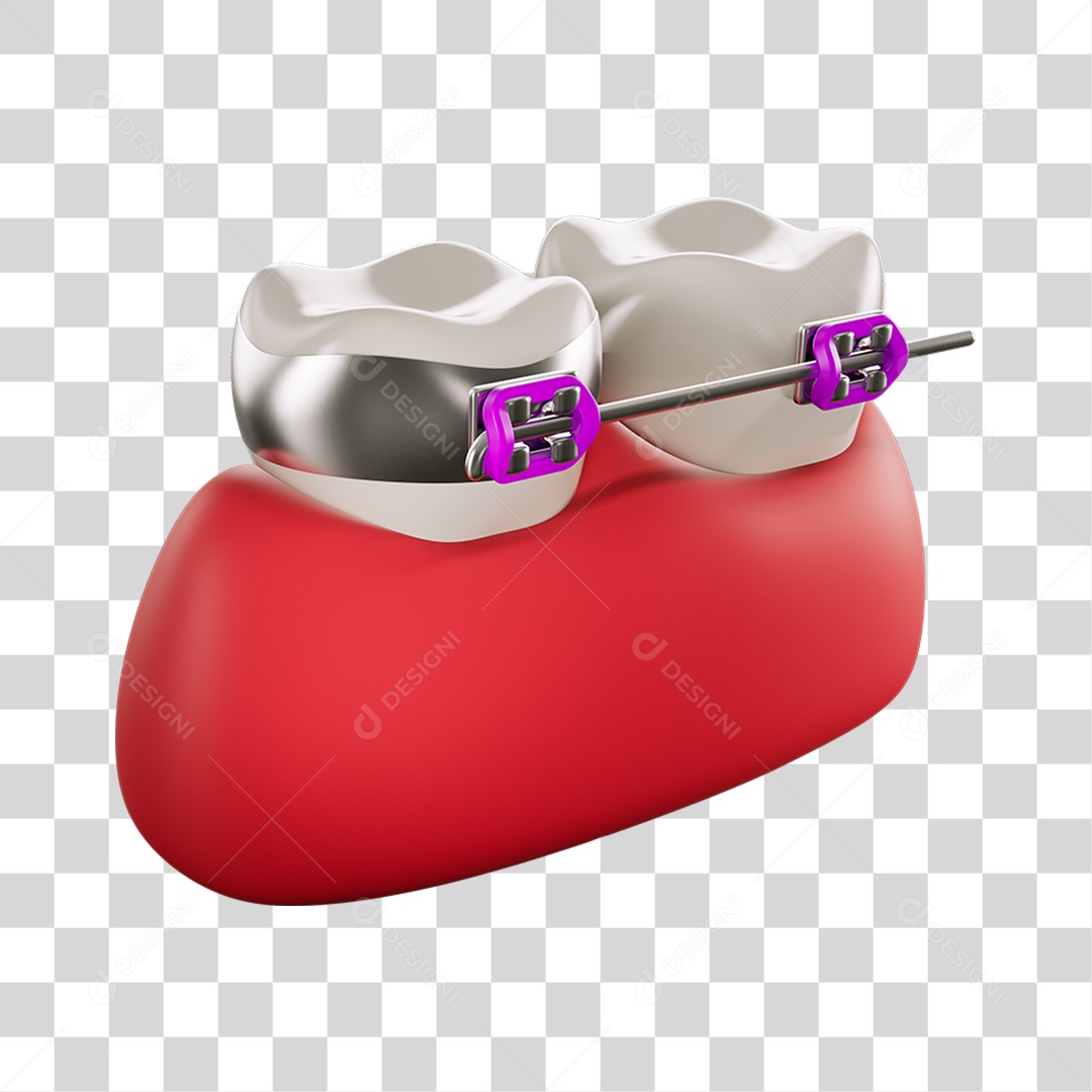 Elemento 3D Dente com Aparelhos Para Composição PNG Transparente