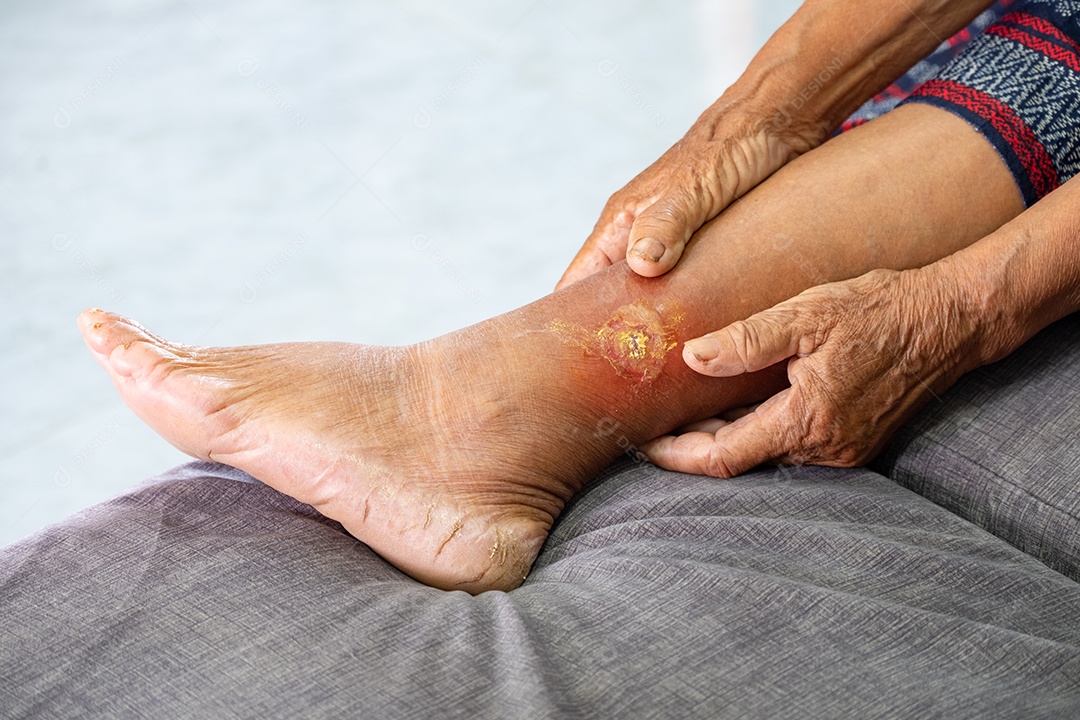 Mulher idosa asiática de mãos dadas na perna com gangrena devido a diabetes, conceito de cuidados de saúde e saúde ocupacional