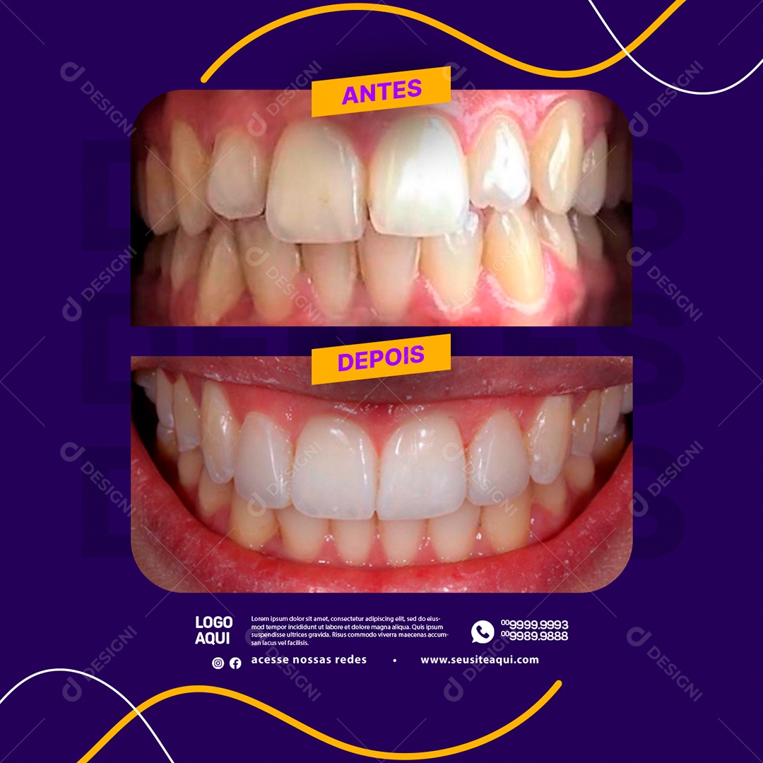 Social Media Odontologia Nome do Procedimento Antes e Depois PSD Editável