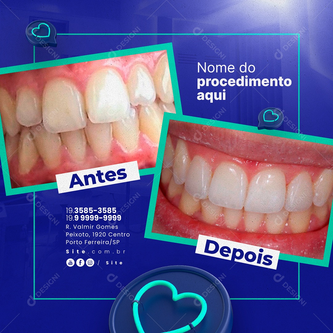 Social Media Odontologia Nome do Procedimento Antes e Depois PSD Editável