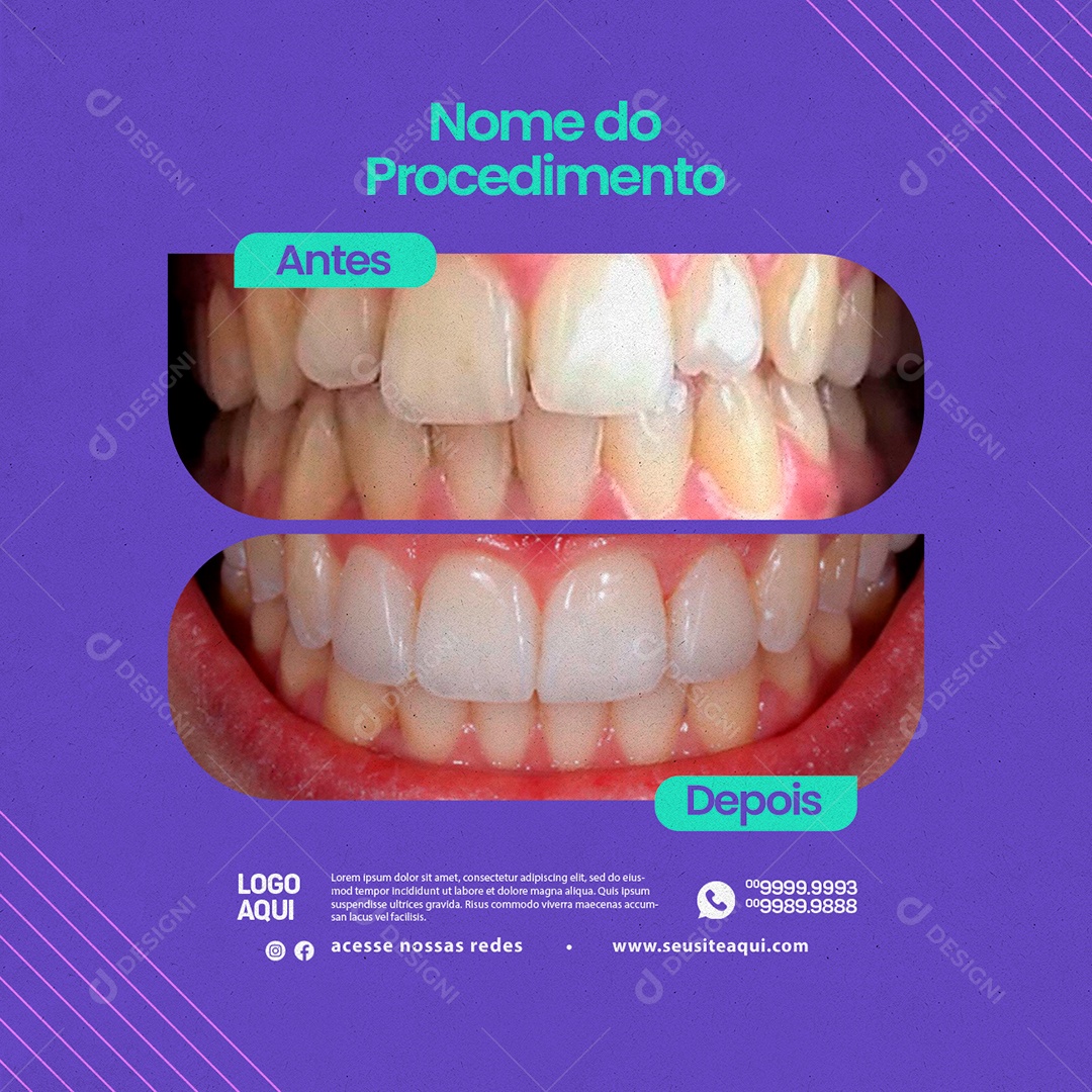 Odontologia Nome do Procedimento Antes e Depois Social Media PSD Editável