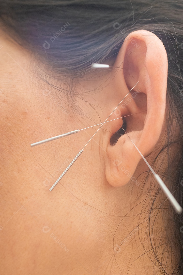 Orelha de mulher com agulhas, close-up. Acupuntura. Medicina chinesa