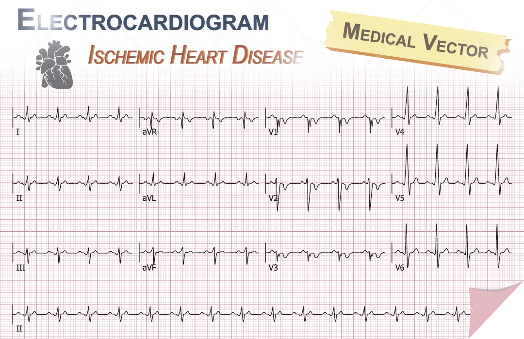 Gráfico de Eletrocardiograma Ilustração Vetor EPS