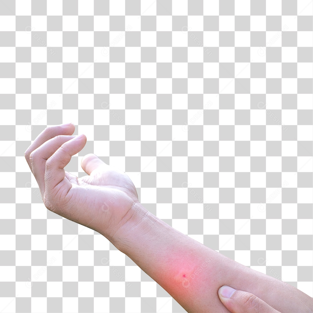 Braço com Ferroada de Abelha PNG Transparente