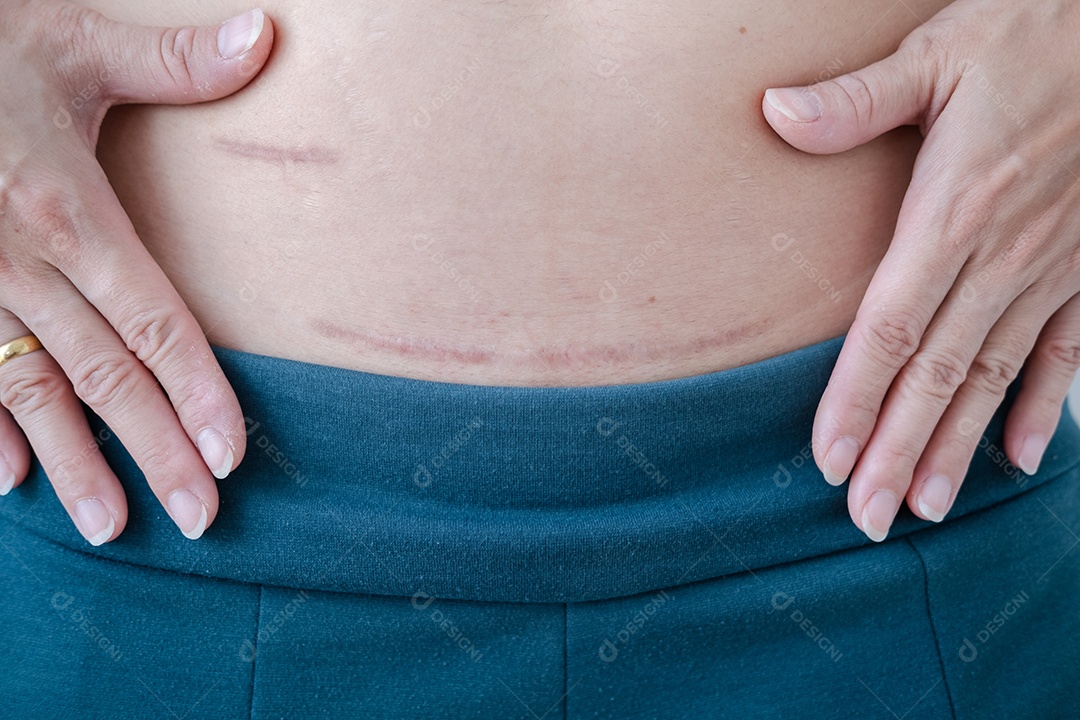 Cicatrizes após cirurgia de apêndice e feridas cirúrgicas pós-parto