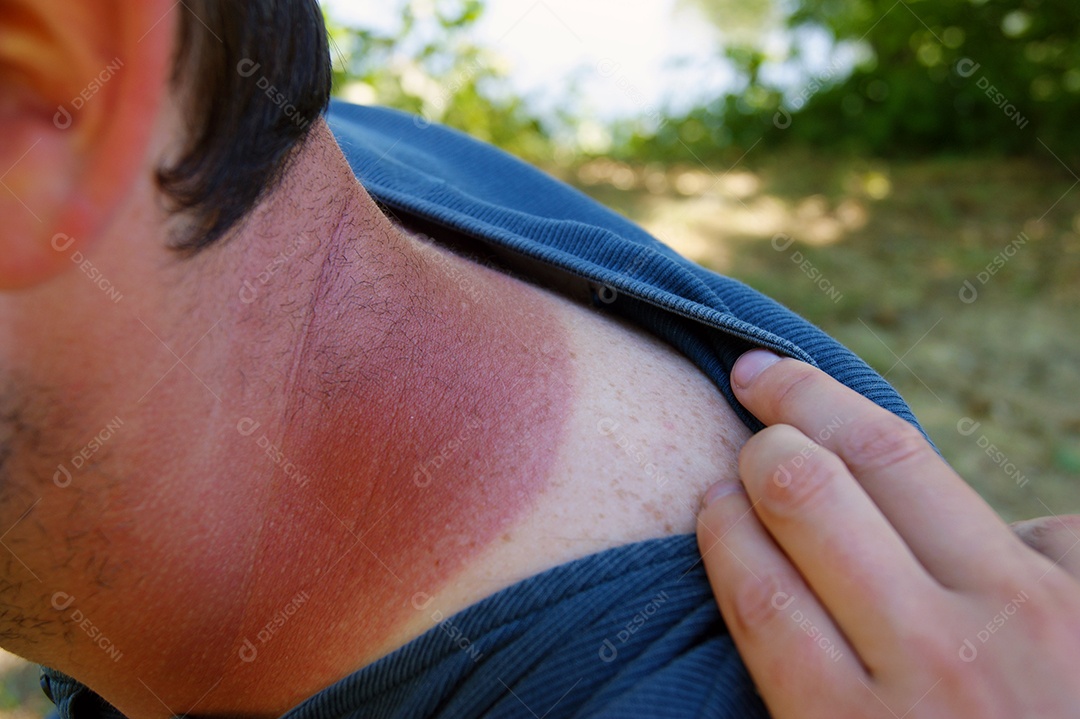 Queimadura solar no pescoço de um jovem