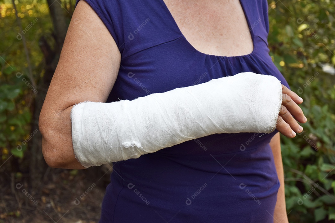 Mulher com braço engessado