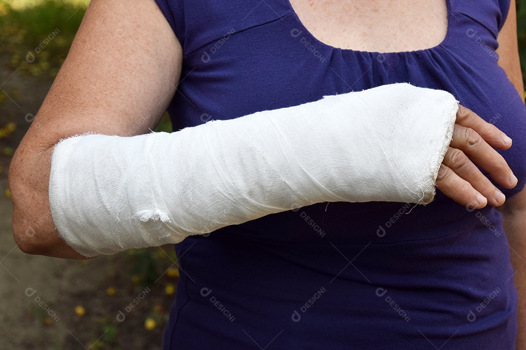 Mulher com braço quebrado engessado