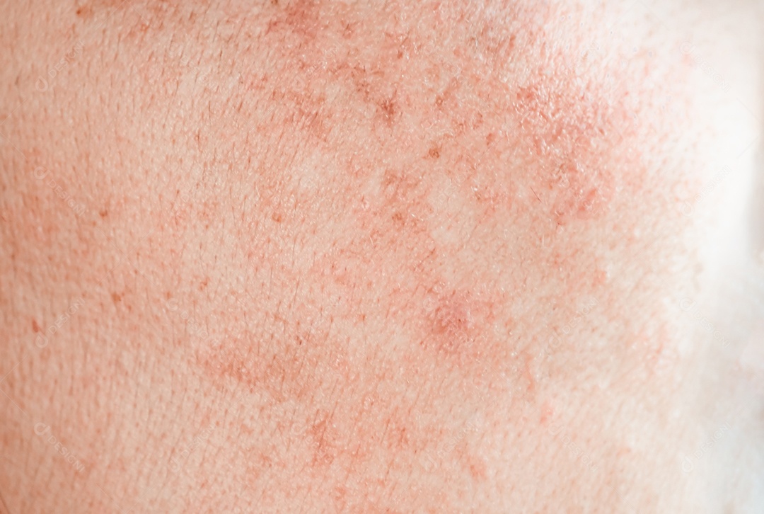 Mais erupções cutâneas vermelhas aparecem no rosto das mulheres