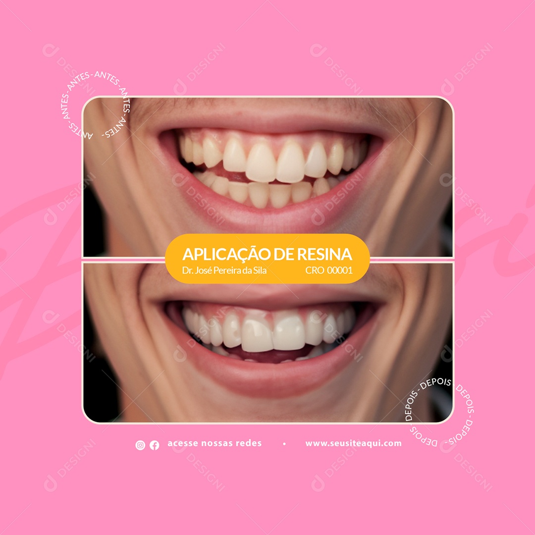 Clínica Odontológica Aplicação De Resina Antes e Depois Social Media PSD Editável