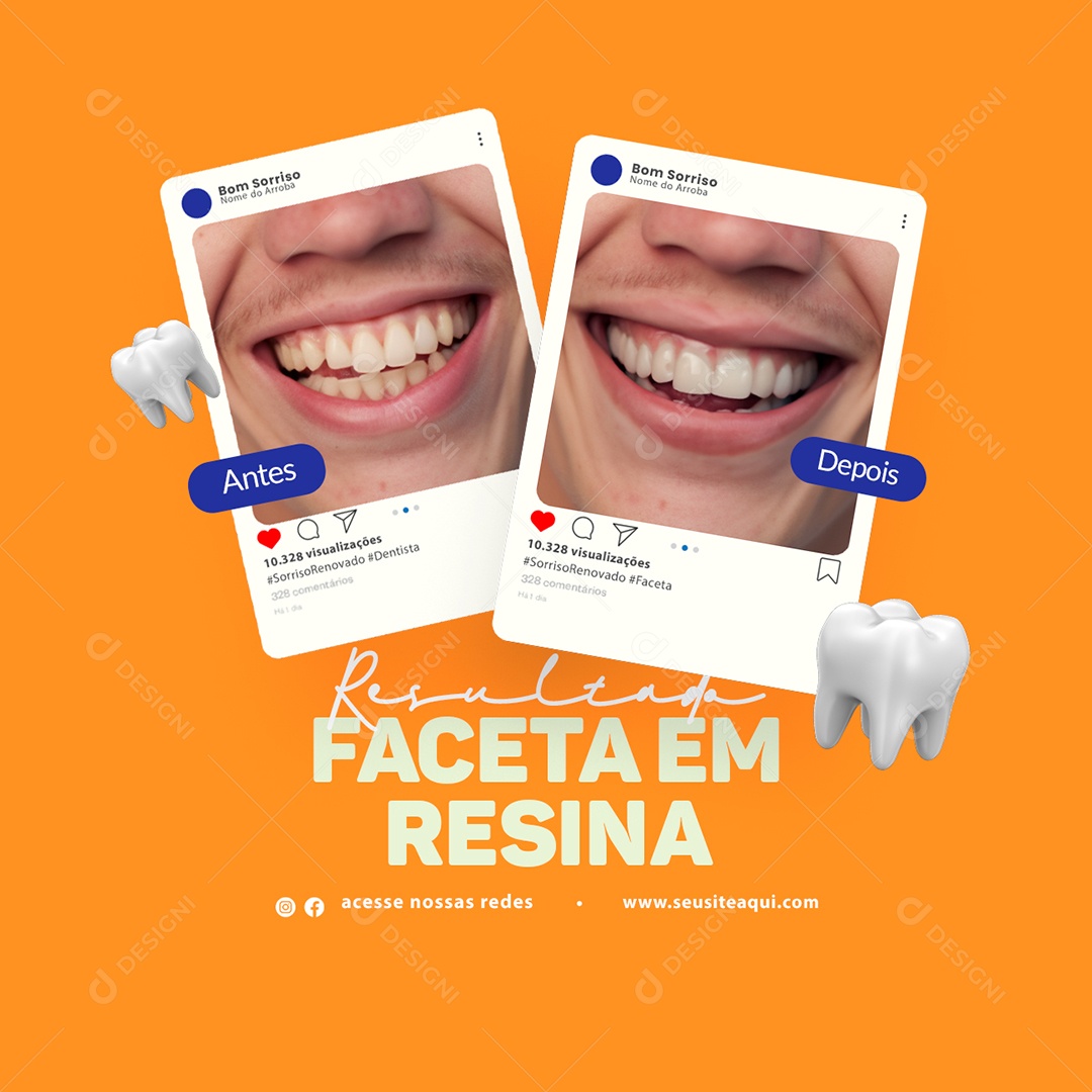 Clínica Odontológica Resultado Facetas em Resina Antes e Depois Social Media PSD Editável