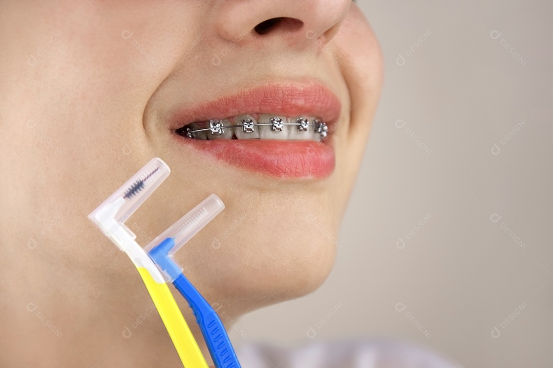 Uma jovem sorrindo com aparelho odontológico